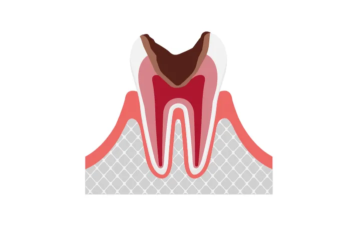 歯の大部分が失われている状態